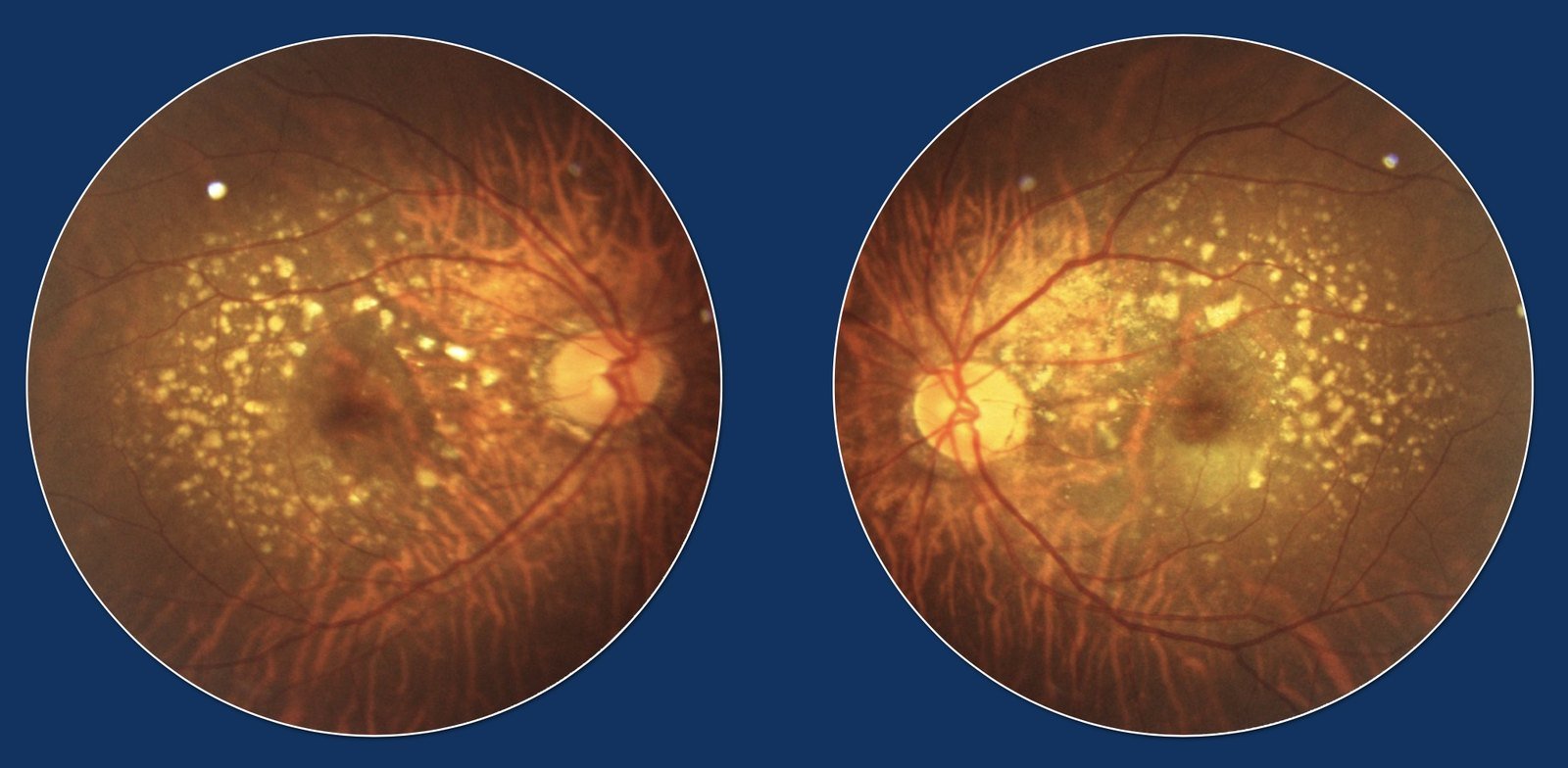 Colour fundus photographs of both eyes