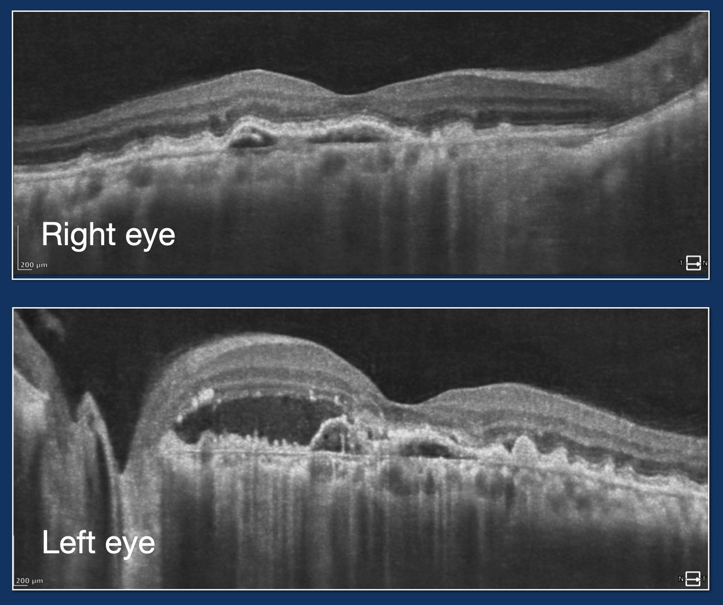 Structural OCT of both eyes
