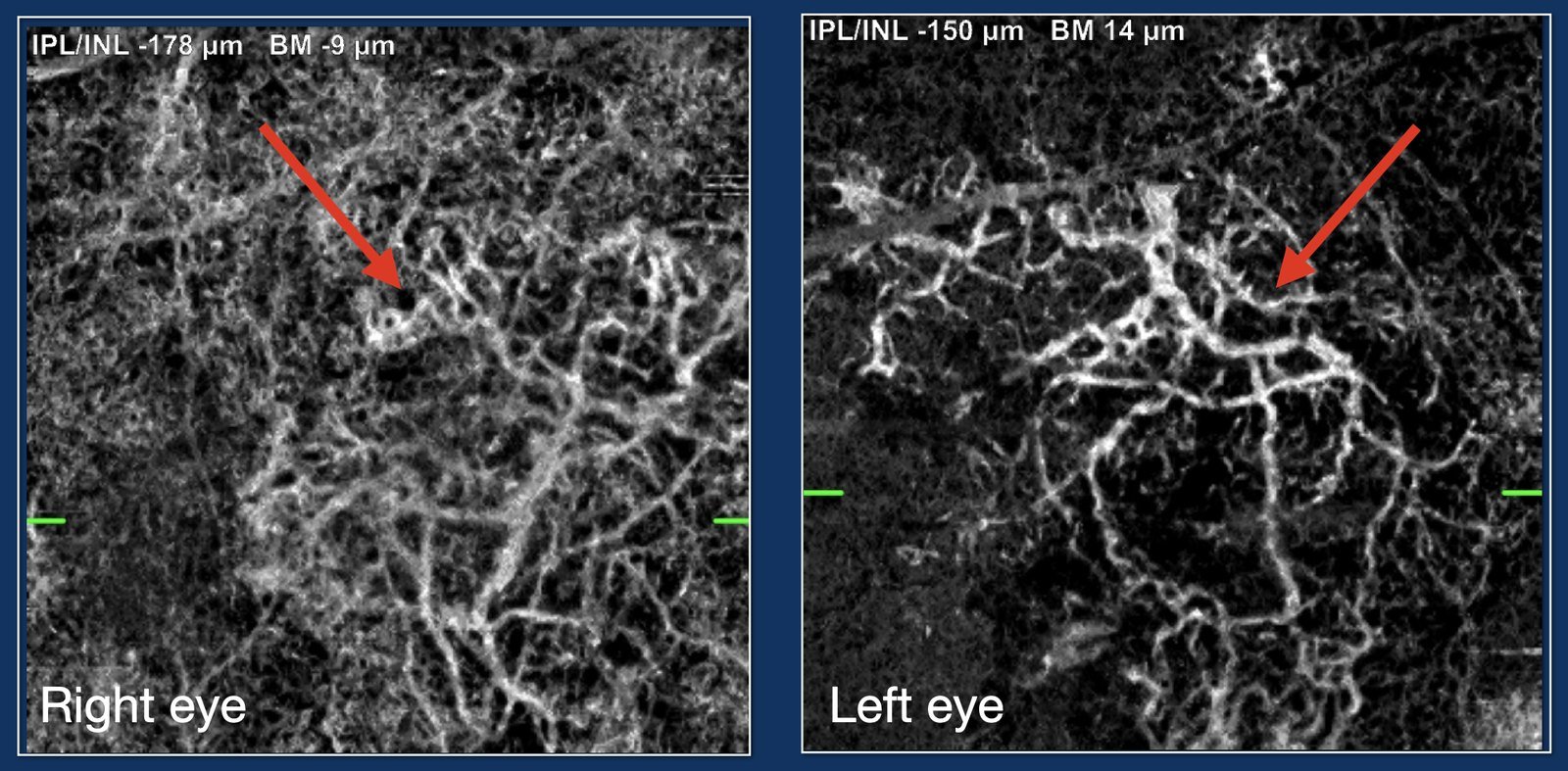 OCT-angiography of both eyes showing a neovascular network