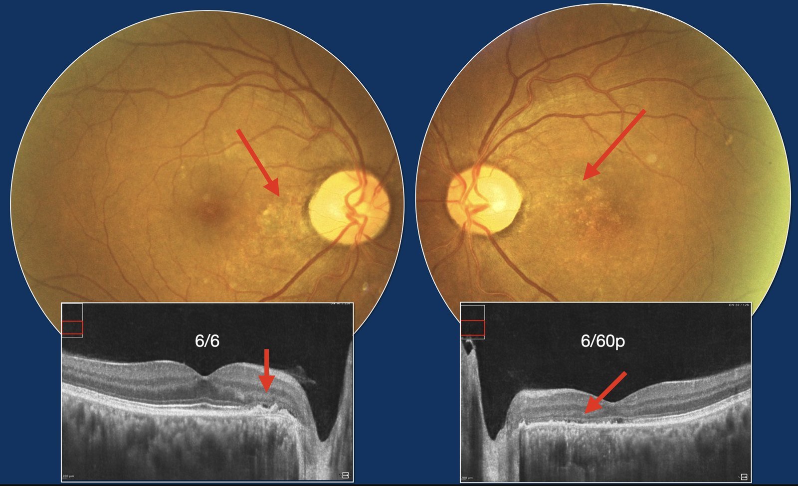 Fundus photographs and OCT of both eyes