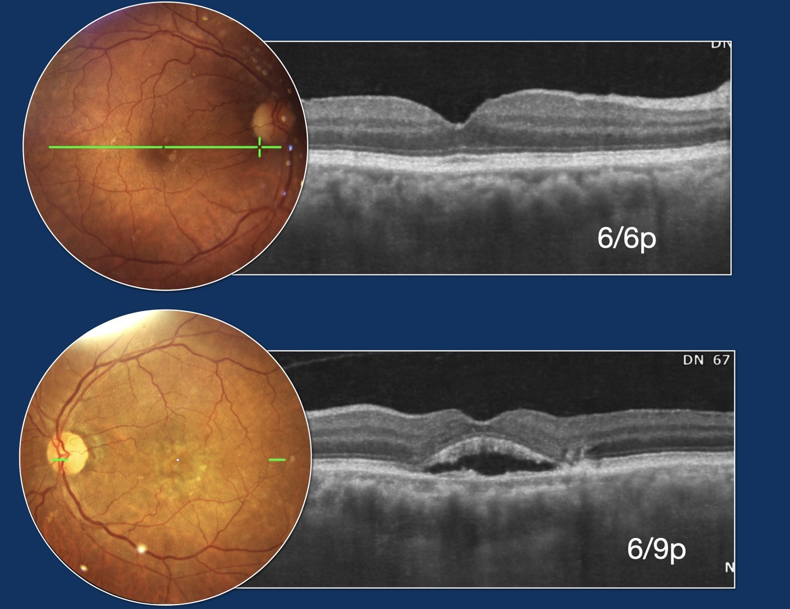 Colour fundus and OCT of both eyes