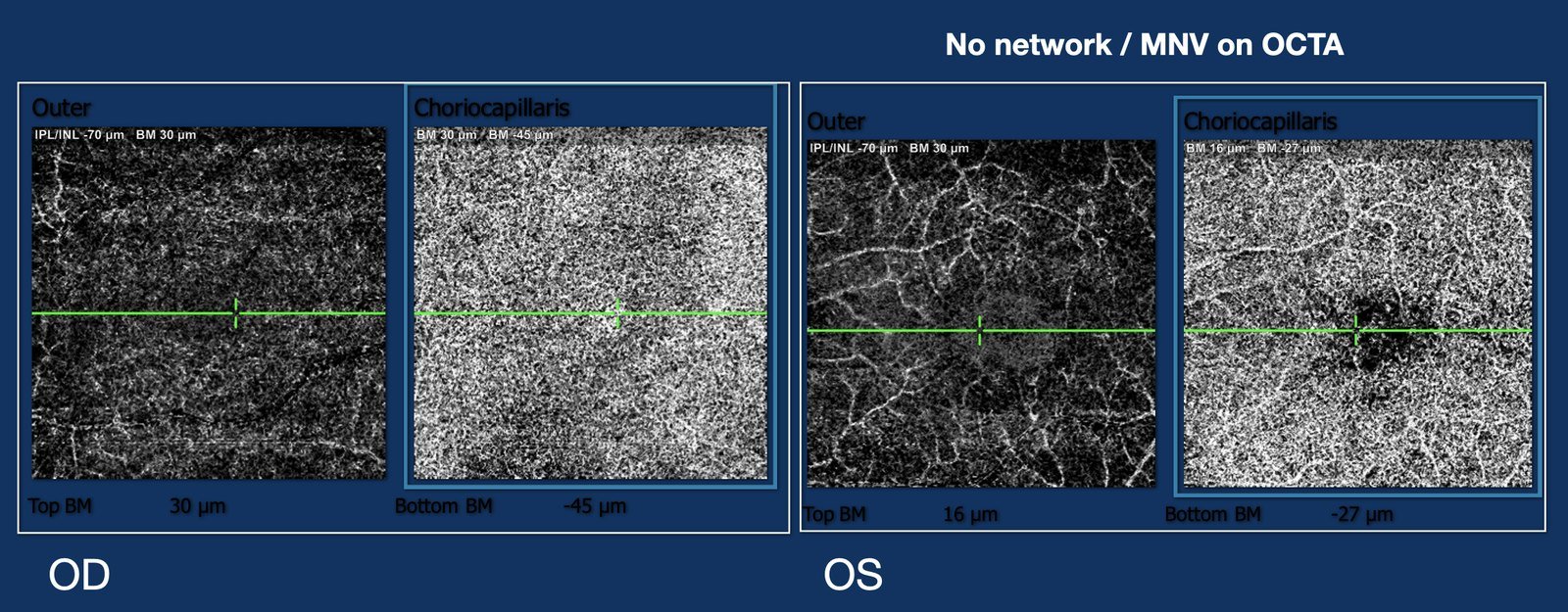 OCT-angiography showing no neovascular network