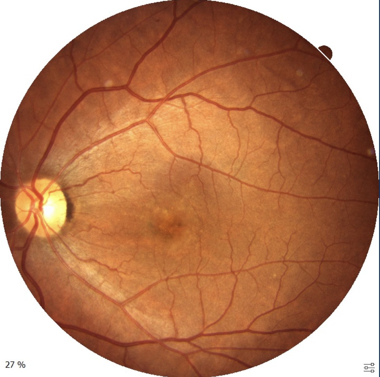 Presenting image of central serous chorioretinopathy