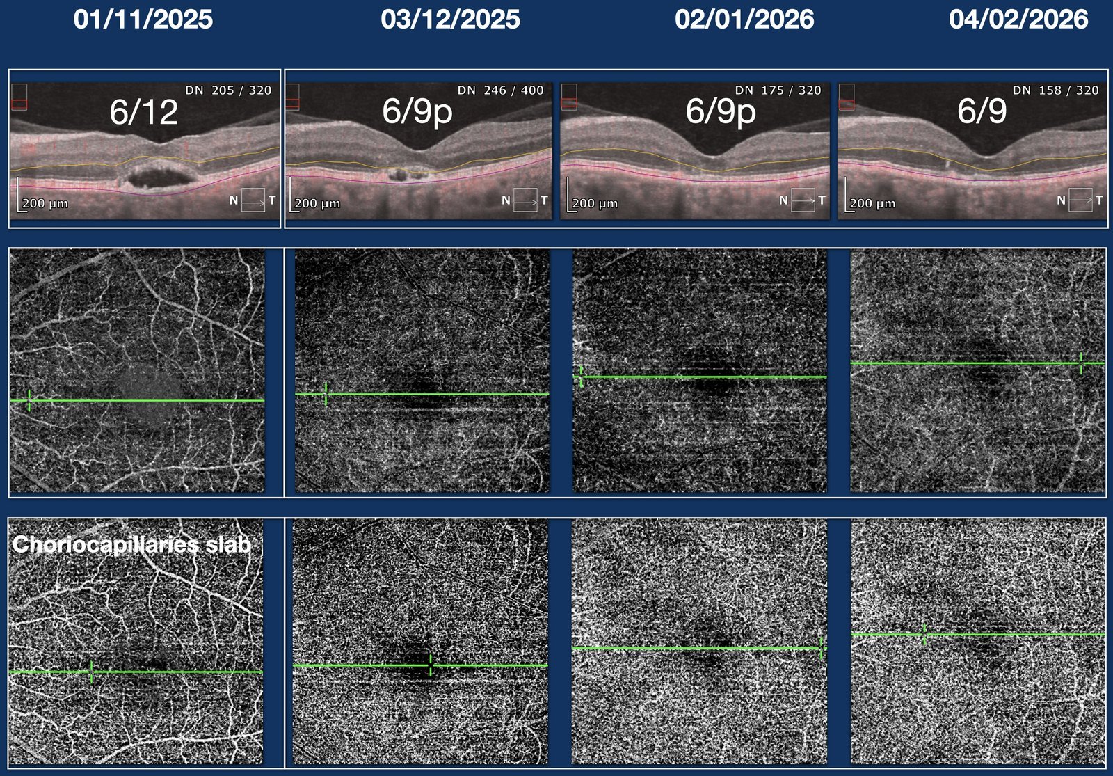 Serial OCT and OCT-angiography showing resolution