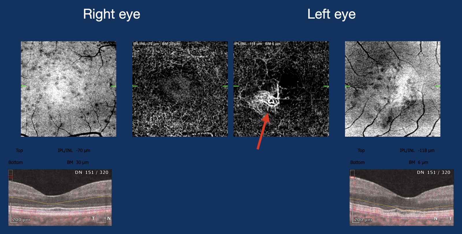 OCT-angiography showing a neovascular network in the left eye
