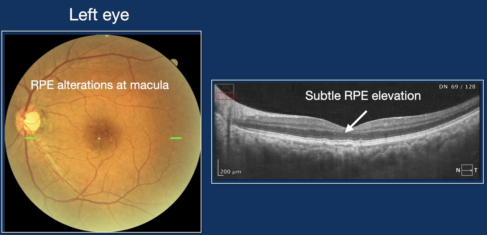 Colour fundus and OCT of the left eye