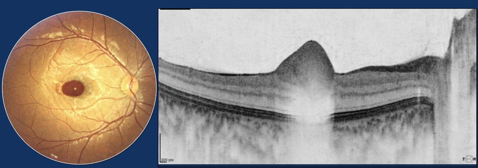 Pre-macular sub-ILM haemorrhage at presentation