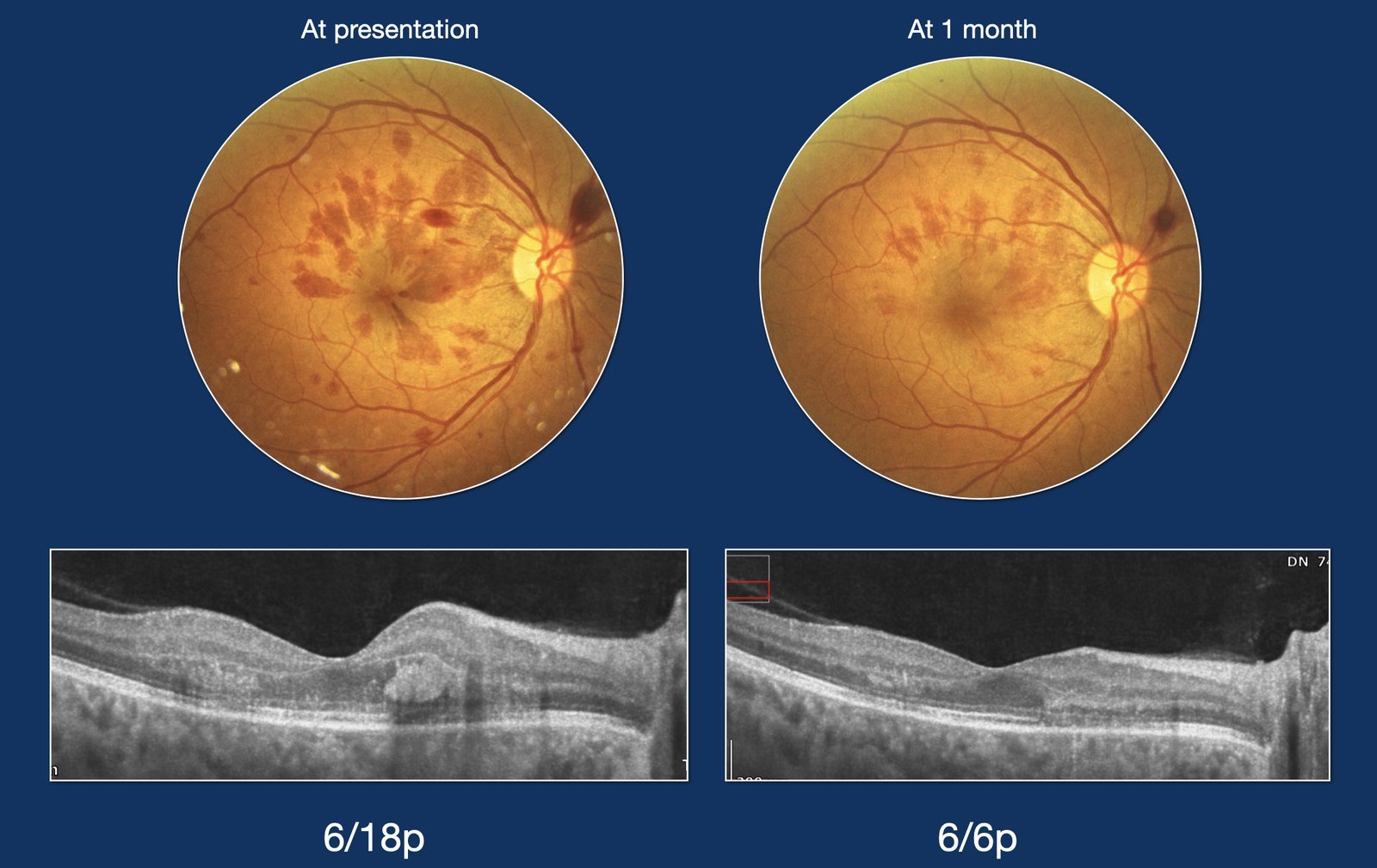 Hypertensive retinopathy at presentation and at one month