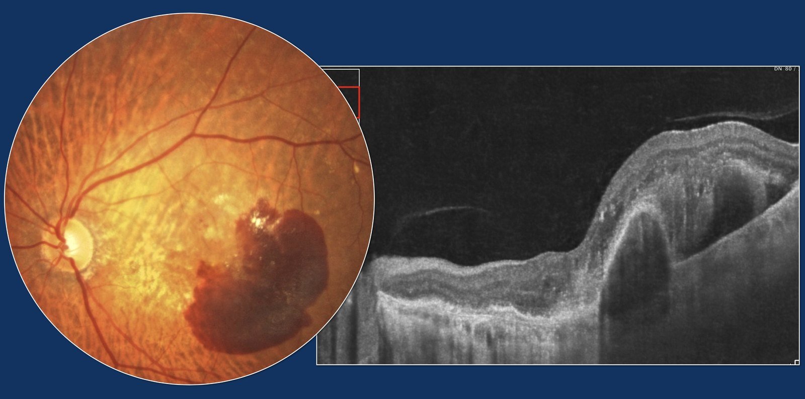 Neovascular AMD at presentation