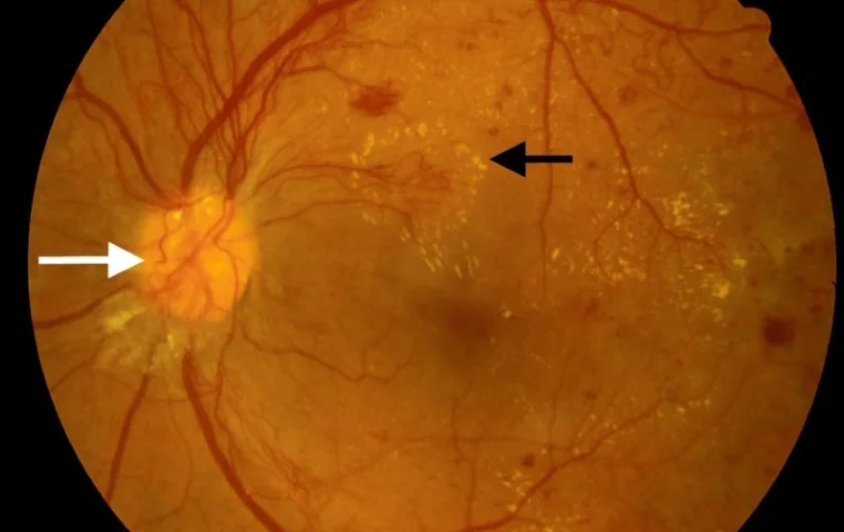 Diabetic macular edema after pars plana vitrectomy — International Ophthalmology