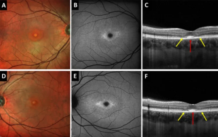 Foveal photoreceptor disruption in ocular diseases — Survey of Ophthalmology